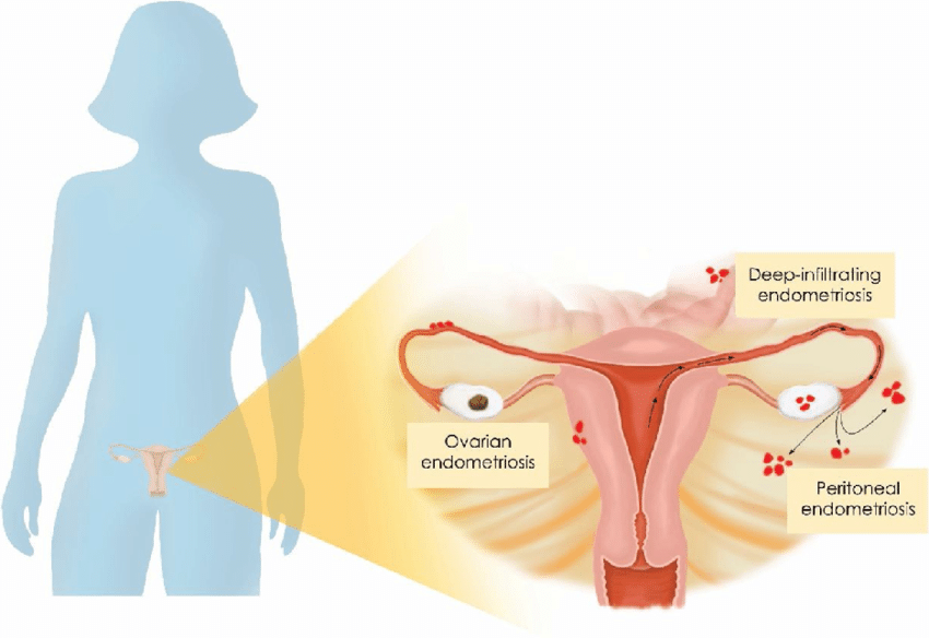 endometriosis